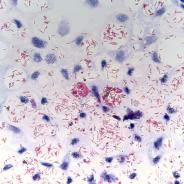 Acid fast stain of mycobacterium.