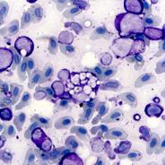 Stained blood smear showing characteristic EIBS inclusion bodies.