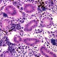 Aeromonas damage to kidney tissue.