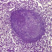 Mycobacterial lesion in liver.