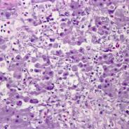 Liver damage caused by Piscirickettsia salmonis.