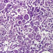 Kidney necrosis and inflammation caused by Renibacterium salmoninarum.