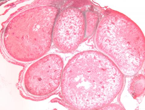 Glugea xenomas in kidney