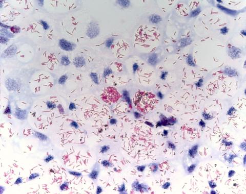 Acid fast stain of mycobacterium.