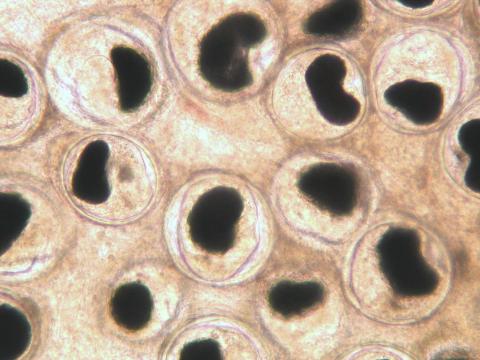 Nanophyetus metacercaria in fresh tissue squash of intestine.