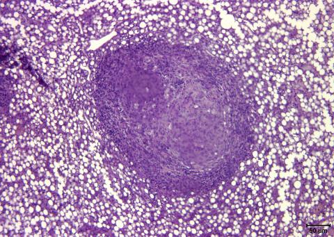 Mycobacterial lesion in liver.