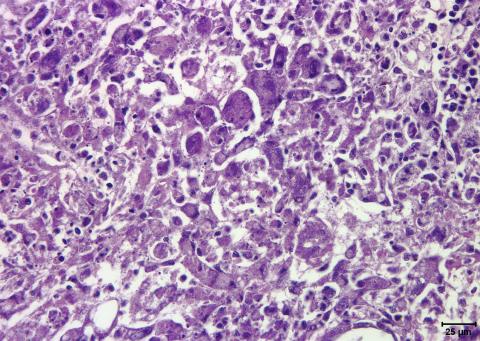 Kidney necrosis and inflammation caused by Renibacterium salmoninarum.