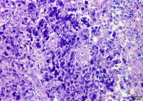 Kidney necrosis and inflammation caused by Renibacterium salmoninarum.