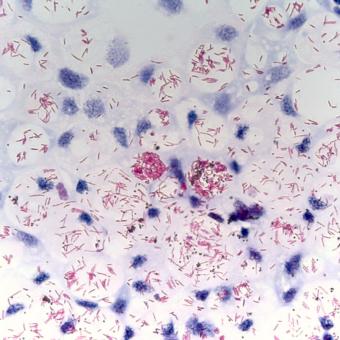 Acid fast stain of mycobacterium.