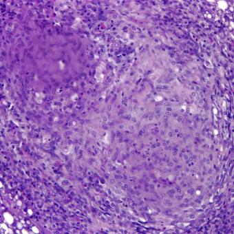 Mycobacterial lesion in liver.