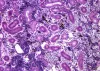 Aeromonas damage to kidney tissue.