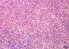 Tissue damage caused by Flavobacterium.